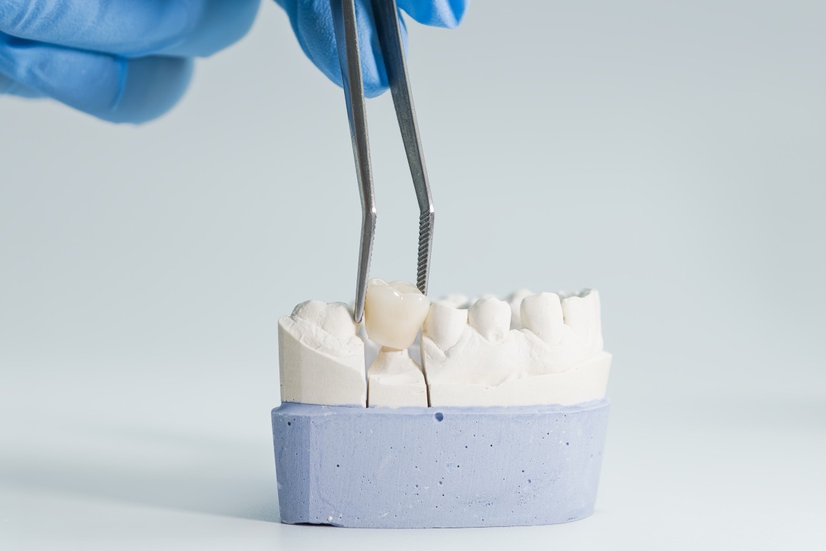 Tweezers placing a ceramic crown onto a plaster dental model