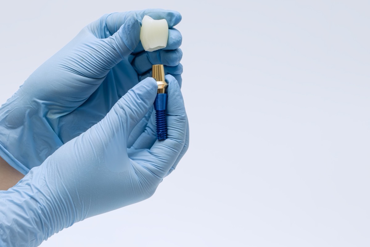 Gloved hands holding a dental implant with a crown above it